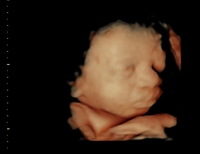 3D ultrasound image at 31 weeks